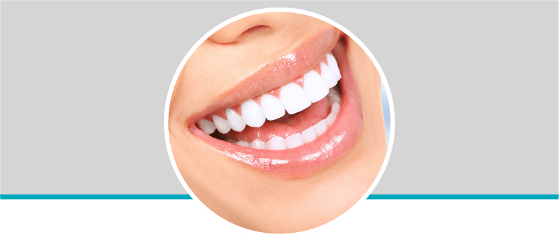 Diseño de sonrisa en resina