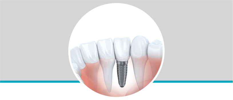 Implantes dentales